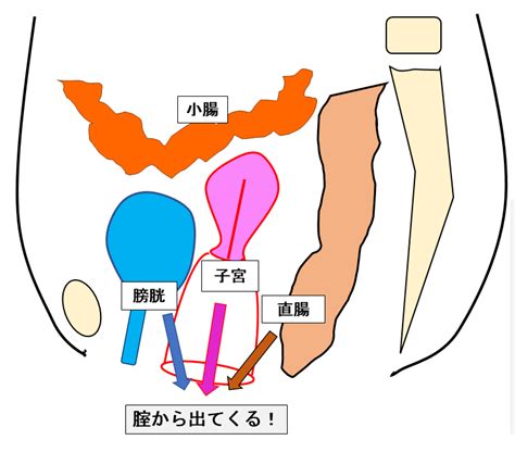 骨盤臓器脱